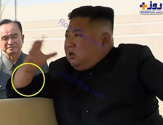 عکس/جای سوزن بر مچ کیم جونگ اون؛ رهبر کره شمالی عمل جراحی انجام داده است؟