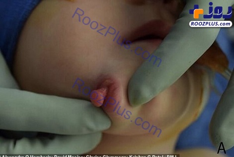 تولد عجیب نوزاد دختر با دو دهان+عکس