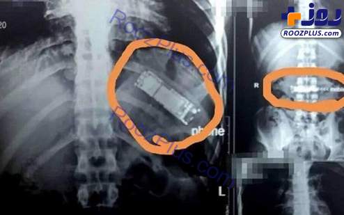 نجات بیمار از خطر انفجار معده اش! + عکس