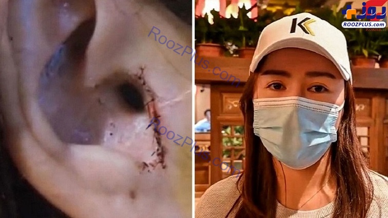 عکس/ گوش یک زن به خاطر عمل جراحی بینی بریده شد