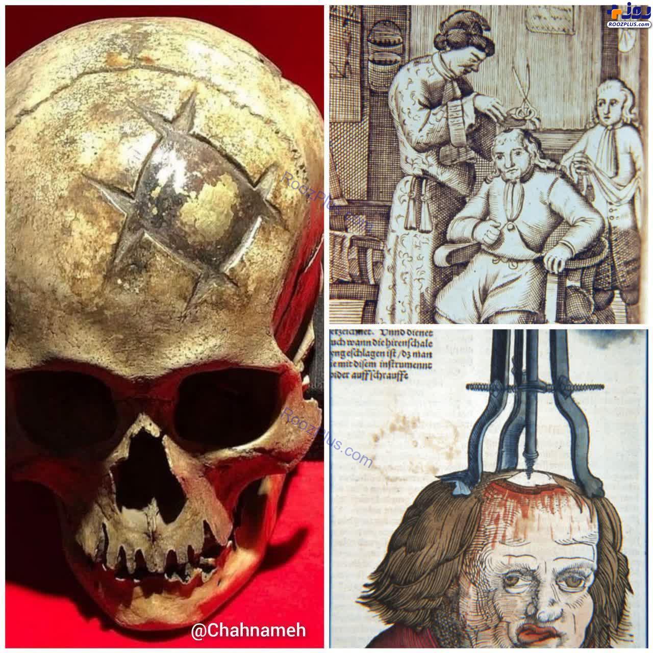 جراحی حیرت انگیز جمجمه در 1600 سال پیش!+عکس