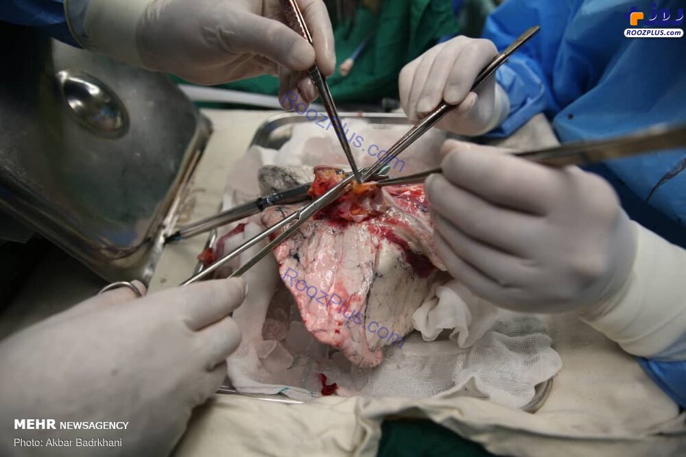 عمل جراحی موفقت آمیز پیوند ریه در بیمارستان مسیح دانشوری +عکس