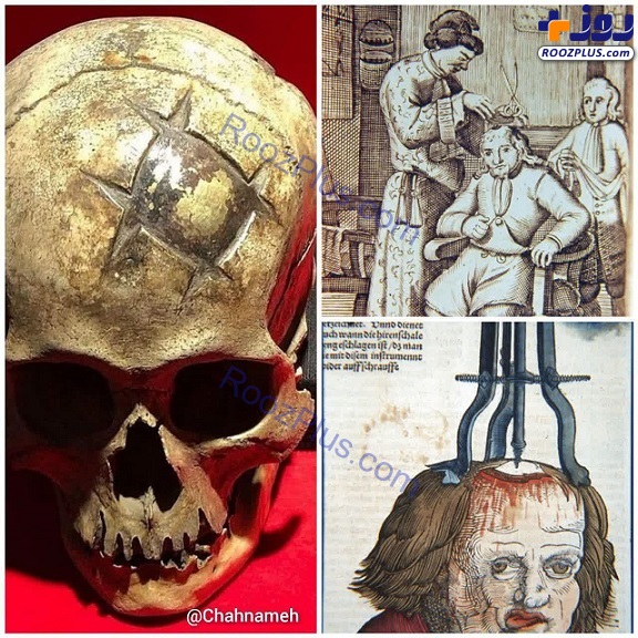 عکس/ جراحی حیرت انگیز جمجمه در ۱۶۰۰ سال پیش!