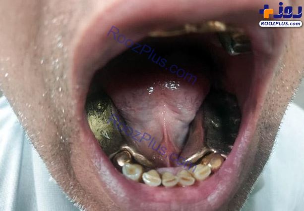 عکس/ قاچاق یک کیلو طلا به شکل دندان مصنوعی