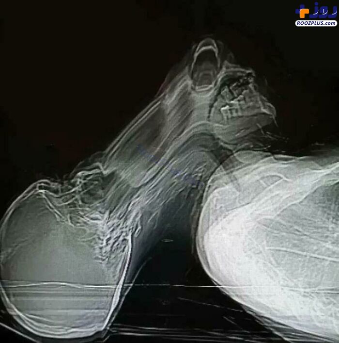 تصویری جالب از لحظه عطسه بیمار هنگام CT اسکن