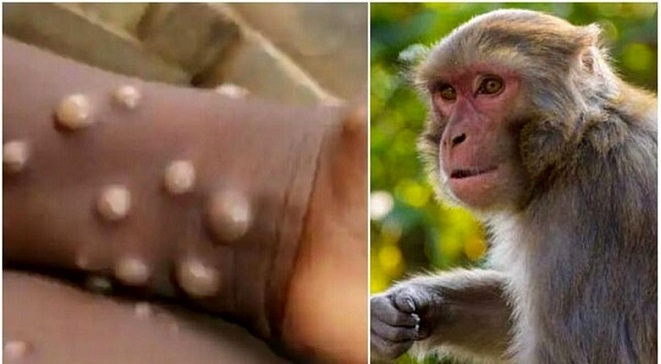 افزایش نگران کننده ابتلا به آبله میمونی در جهان