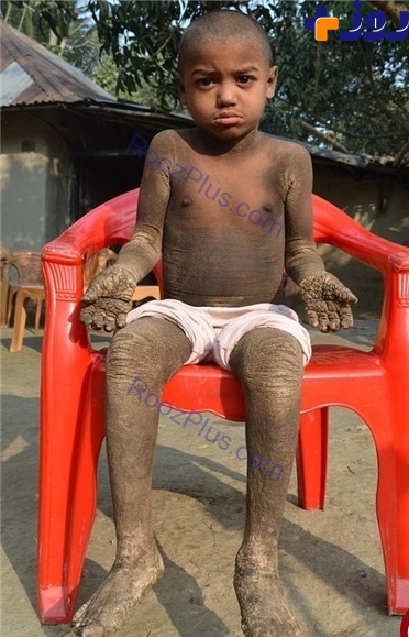 بیماری نادری که این پسر را به سنگ تبدیل کرده است +عکس