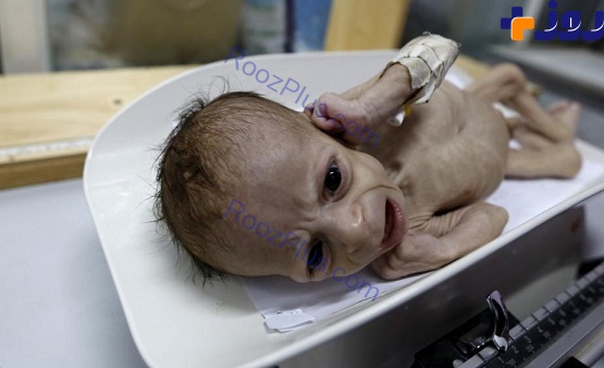 عکس سوء تغذیه حاد در کودکان و نوزادان یمنی