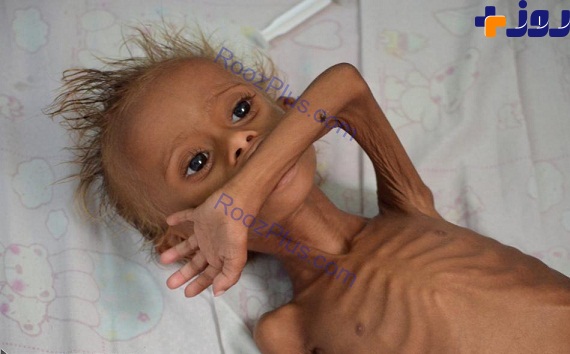 عکس سوء تغذیه حاد در کودکان و نوزادان یمنی