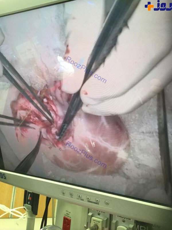 اقدام جالب والدین نوزاد 4 ماهه در هنگام عمل پیوند فرزندشان+تصاویر(18+)