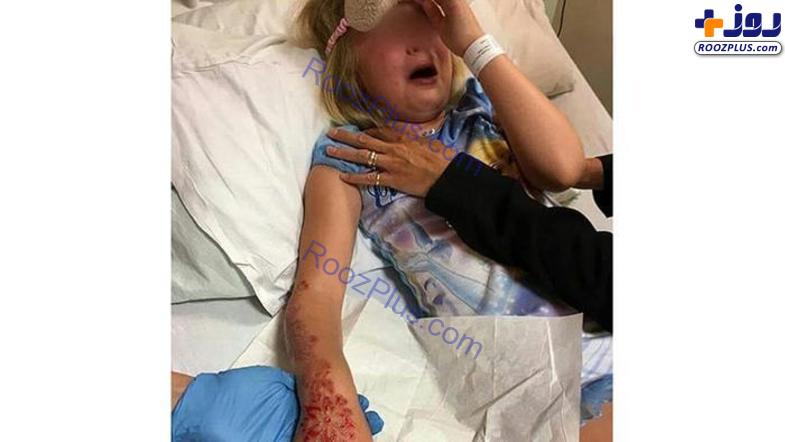 دست دختر ۶ ساله با تتو حنا جزغاله شد! +تصاویر