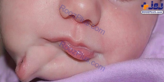 عکس/ تولد نوزادی با دو دهان در آمریکا