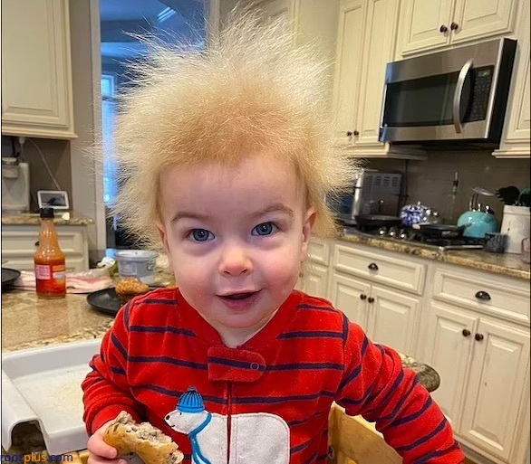 موهای عجیب یک کودک به دلیل بیماری نادر+ تصاویر