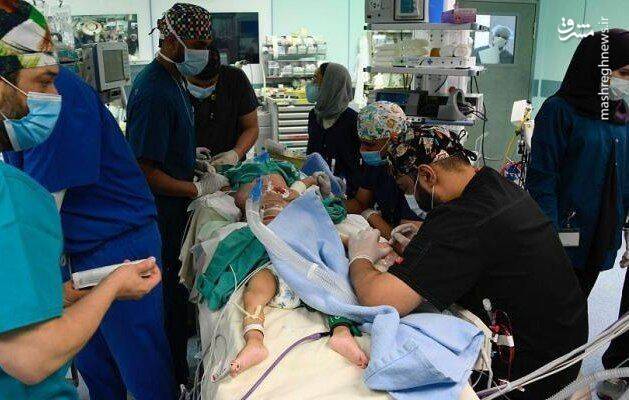جداسازی دوقلوهای یمنی پس از ۱۵ ساعت عمل جراحی +عکس