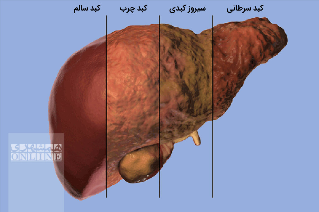 عواملی که بیماری کبد چرب را به سرطان نزدیک می‌کند