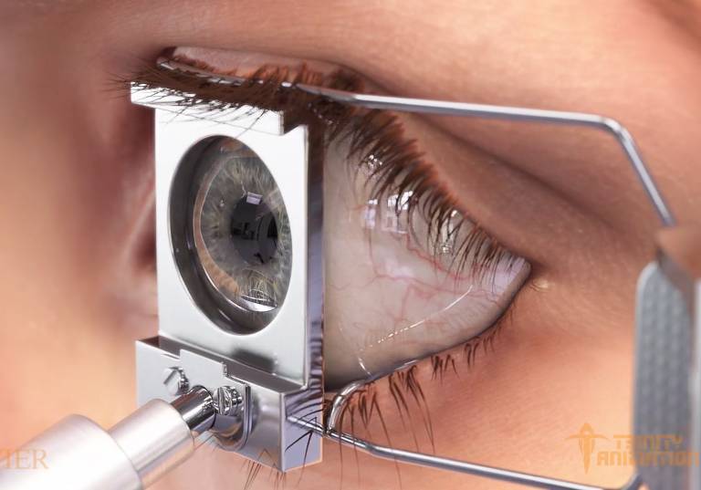 هزینه عمل لیزیک چشم: عوامل تعیین‌کننده و شرایط پوشش بیمه در سال 1402