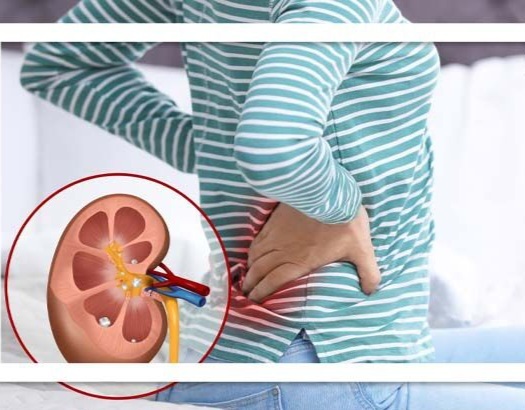 روش های موثر در پیشگیری از سنگ کلیه روش های موثر در پیشگیری از سنگ کلیه