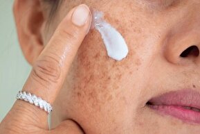 هشدار؛ مراقب سوختگی‌های پنهان آفتاب باشید