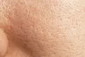 چگونه جای جوش را از بین ببریم؟