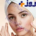 بعد از وکس چه کنیم که جوش نزنیم؟
