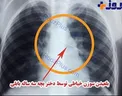 دختر سه ساله بابلی سوزن خیاطی را بلعید +عکس