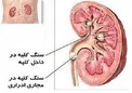 راهکار اصلی پیشگیری از سنگ کلیه