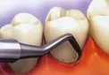 چگونه دندان ها را در منزل جرم گیری و سفید کنیم +دستورالعمل