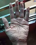 عکس شوکه کننده از دست پرستار بخش کرونا