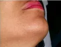 بلایی که لیزر بر سر پوستتان می آورد!