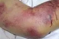 مرگ یک نفر بر اثر تب کریمه کنگو در گیلان