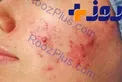 بلایی که استرس بر سر پوست می آورد!
