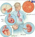 تاثیرات فشار خون بر بدن + عکس