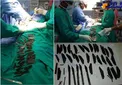 40 چاقو در معده بیمار +عکس