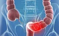 دلایلی که موجب سرطان روده بزرگ می شود
