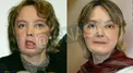 اولین کسی که تحت جراحی پیوند صورت قرار گرفته بود+عکس