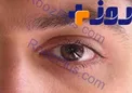 از بیماری «میگرن چشمی» بیشتر بدانید