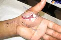 انجام عمل پیوند انگشت نادر در مشهد +عکس
