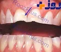 با حساسیت عاج دندان آشنا شوید