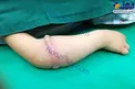 کش پلاستیکی که جذب گوشت دختربچه شد! + عکس