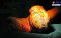 عکس/ تومور وحشتناکی که از پای بیمار بیرجندی خارج شد!
