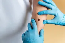 شایع ترین سرطان در جامعه/ هرگز از سولاریوم استفاده نکنید