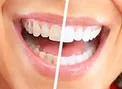 ۶ ترفند خانگی که لبخندی زیبا به شما هدیه می‌کند