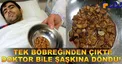 مقدار باورنکردنی سنگهای خارج شده از کلیه یک مرد!+عکس