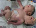عکس/ تولد نوزادی با دو سر و سه دست در کشور هند