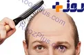 داروهای خوراکی ضد ریزش و پر پشت کردن مو