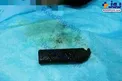 خارج کردن چراغ قوه از معده یک مرد + عکس