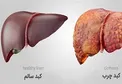 علائم هشدار دهنده ای که خبر از کبد چرب می دهد