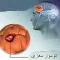 علائم ساده تومور مغزی را بشناسید