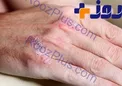 این نشانه ها از سرطان پوست خبر می دهند