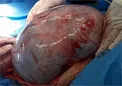 خارج کردن توده ۲۲ کیلوگرمی از شکم یک بیمار!